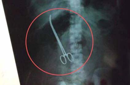 surgeons found Scissors in a woman stomach, left before 3 months surgeons found Scissors in a woman stomach, left before 3 months